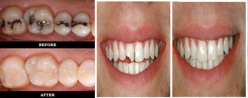 Best Dentist For Cosmetic Tooth Filling in Bandra & Chembur