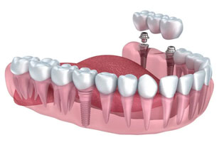 Best Dentist & Dental Clinic in Bandra & Chembur