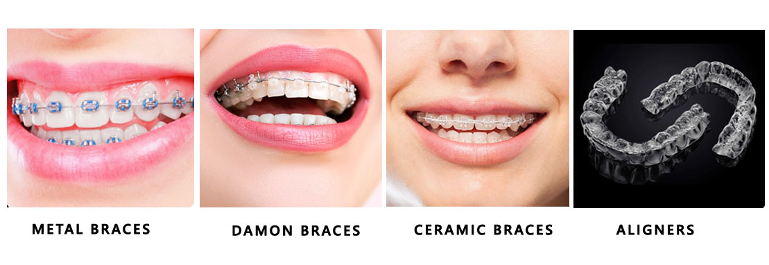 Orthodontic treatment in Bandra
